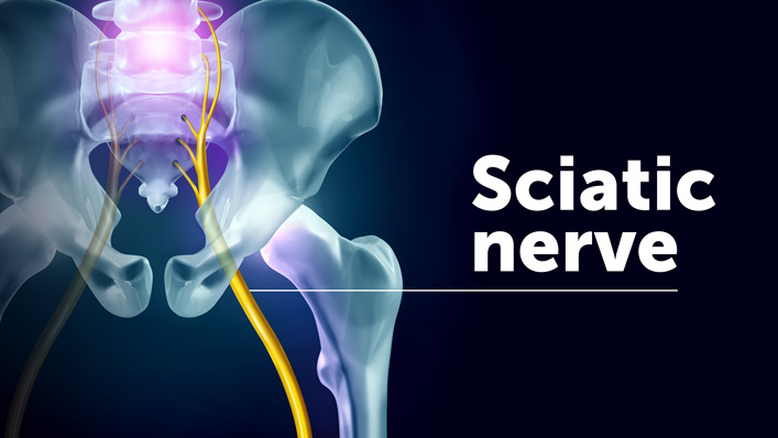 Causes of Sciatica and Sciatic Nerve Pain